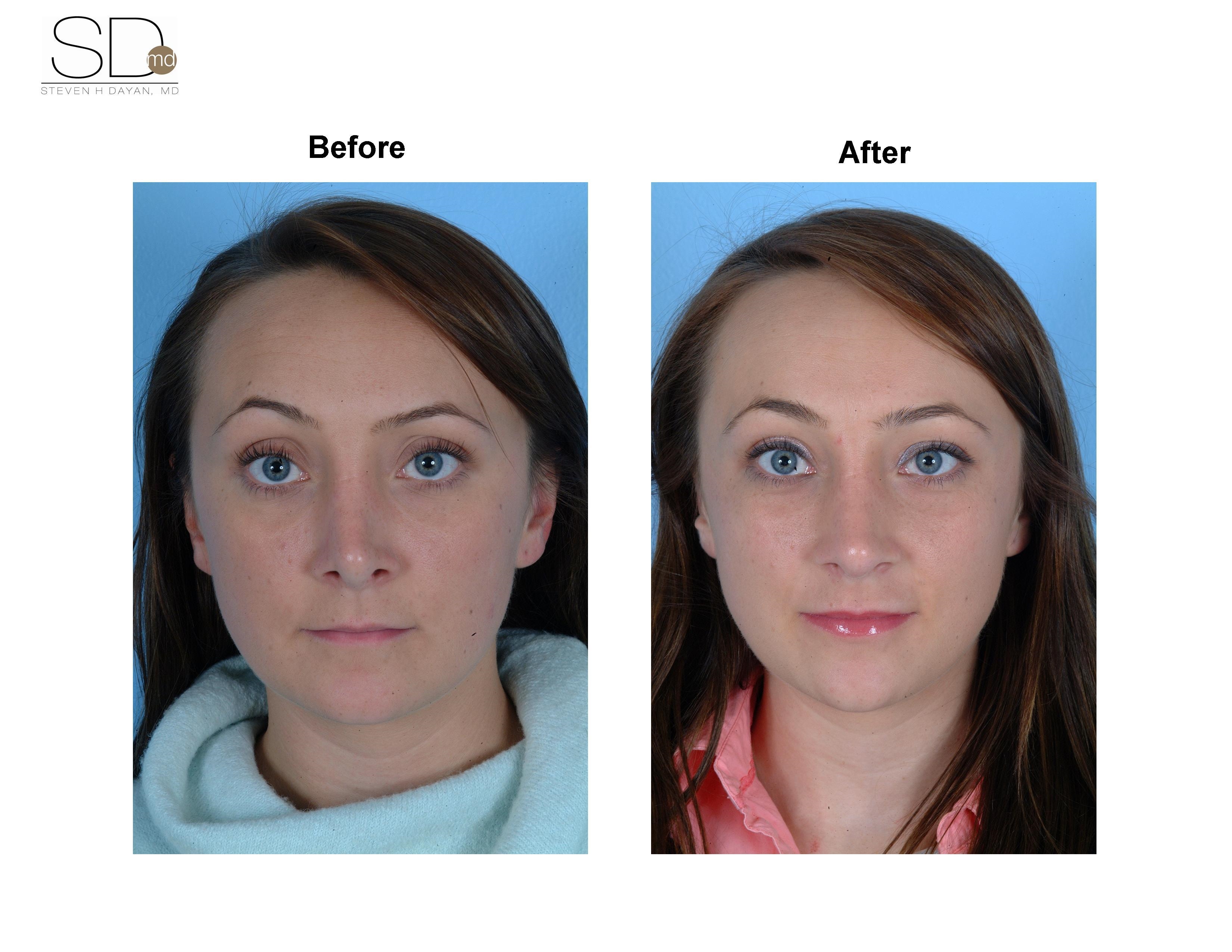 swelling after open rhinoplasty