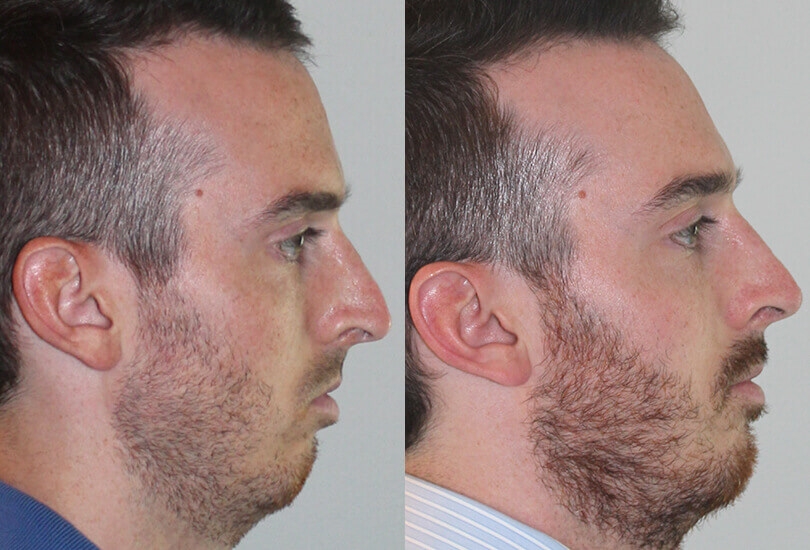 swelling after open rhinoplasty
