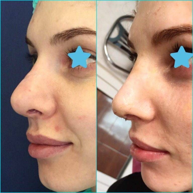 swelling after open rhinoplasty